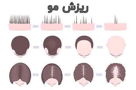 مراحل ریزش مو در زنان