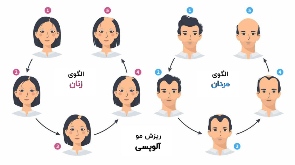 مراحل ریزش مو در زنان و مردان