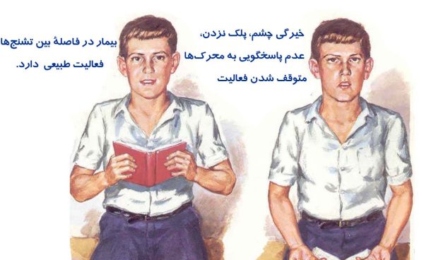 صرع ابسنس