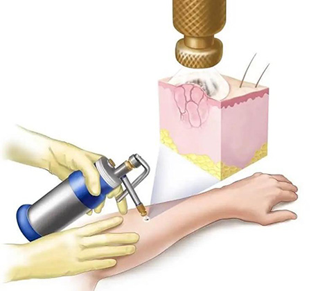 کرایوتراپی (Cryotherapy) یا سرما درمانی برای از بین بردن خال