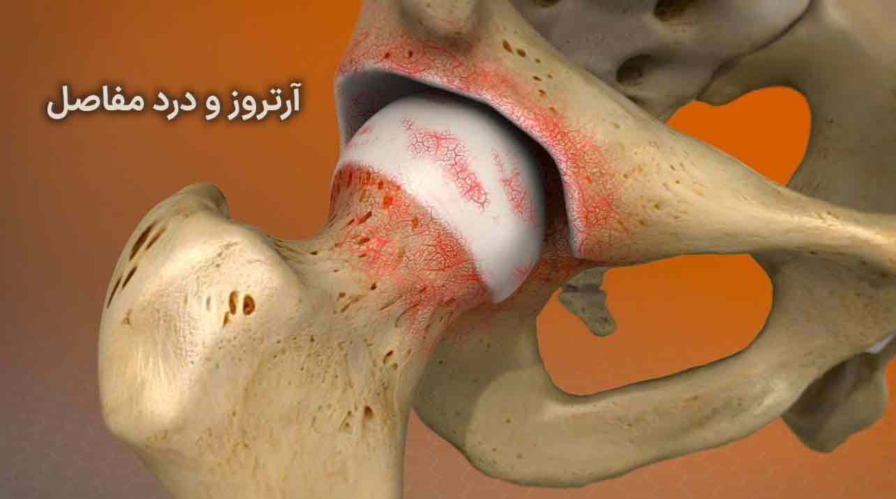 آرتروز و درد مفاصل