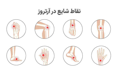 ارتروز