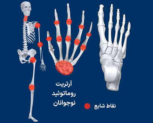 روماتیسم
