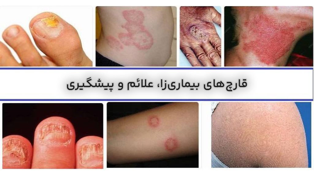 بیماری قارچ