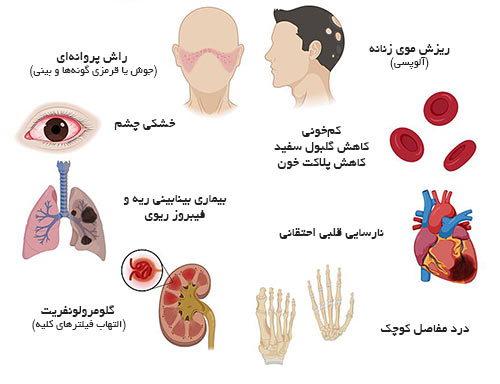 بیماری خودایمنی
