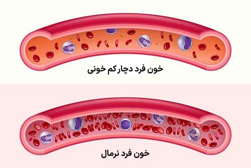 کم خونی