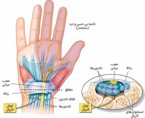 تونل کارپال۵ تونل کارپال